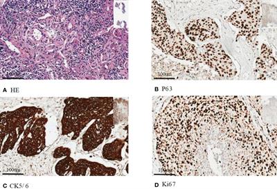 Squamous cell lung carcinoma with gastrointestinal metastasis: a case report and review of literature